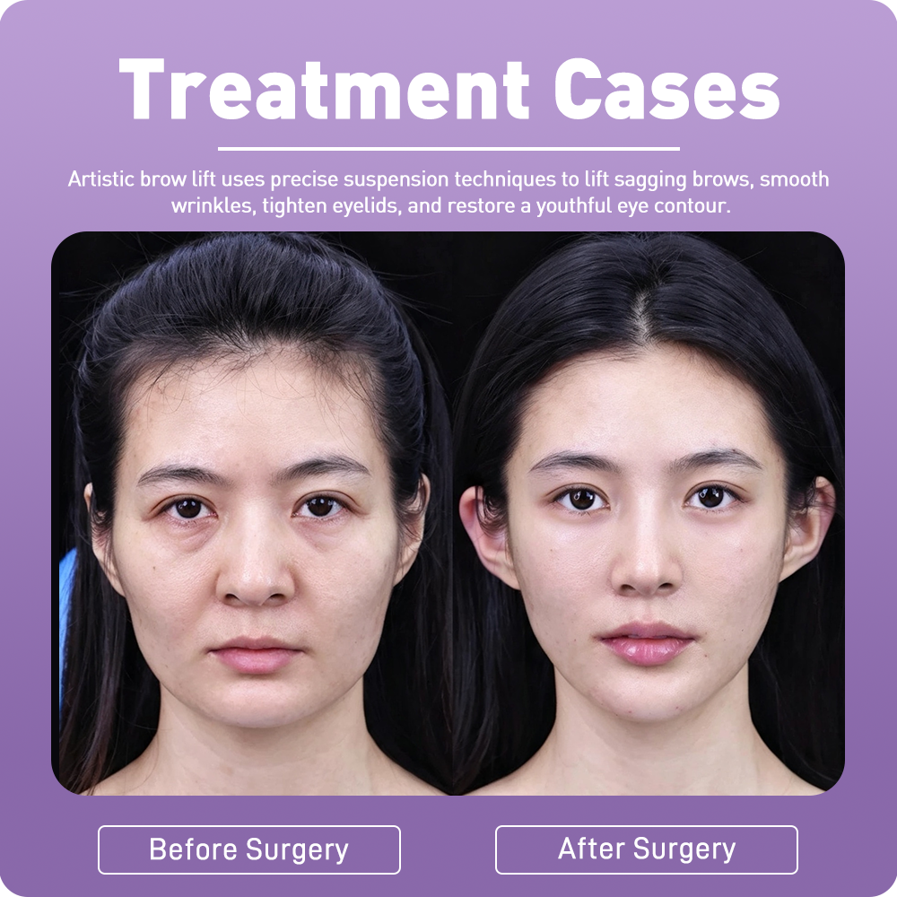 Artistic Facical Sculpting · Brow Lift