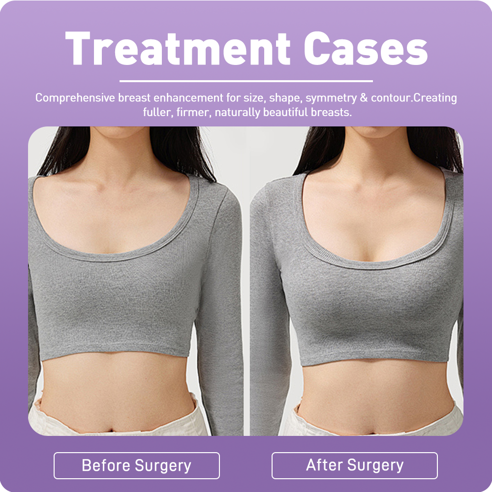 Sculpt Your Ideal Breast Shape